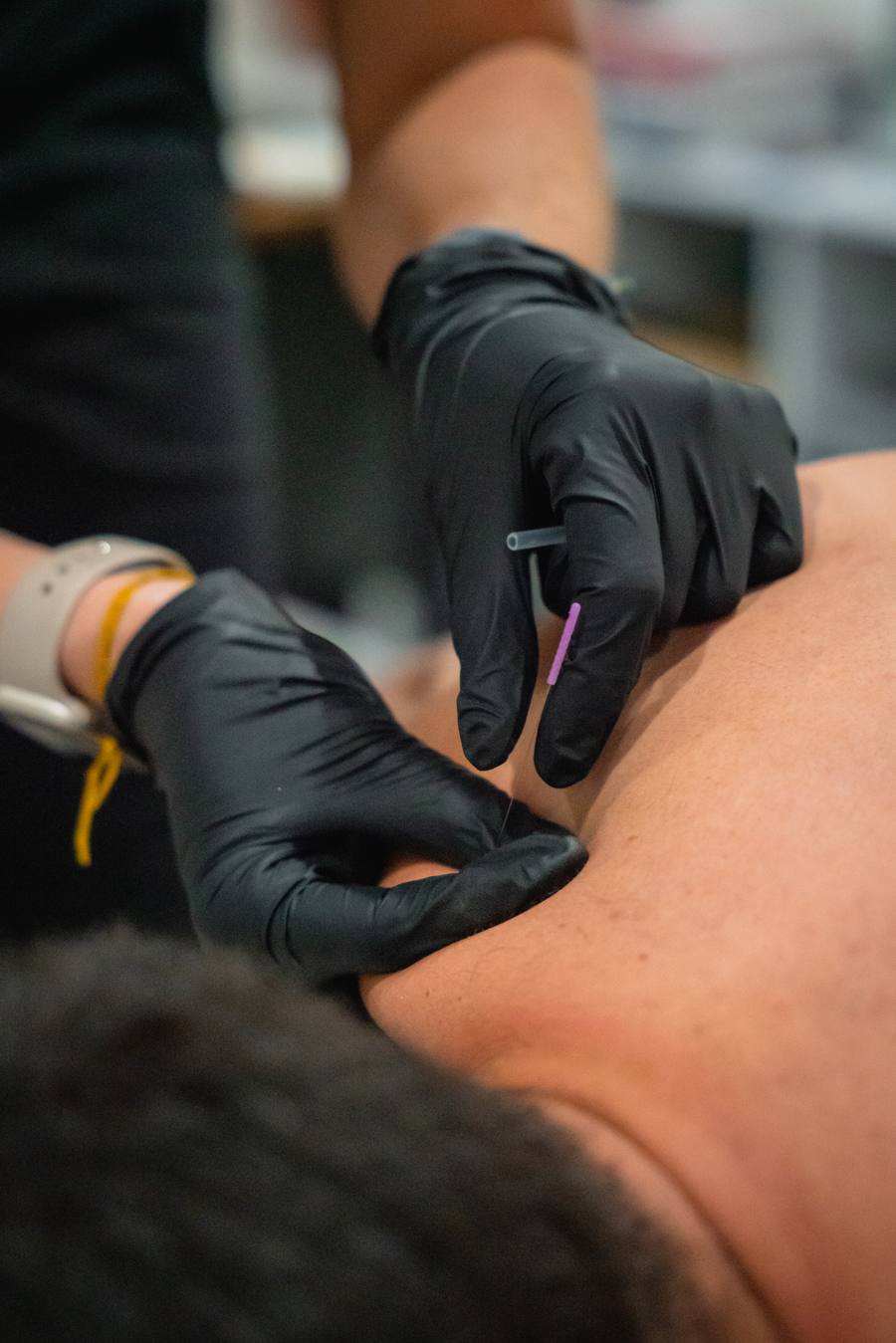 Dry Needling